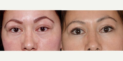 35-44 year old woman treated with Belotero - 1 syringe Belotero to under eye