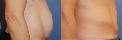 45-54 year old woman treated with Tummy Tuck - 43 year old woman undergoing tummy tuck