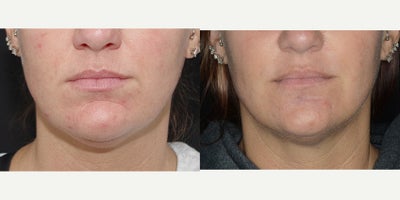 35-44 year old woman treated with Asian Rhinoplasty - 39 year old female treated with Bellafill to the chin