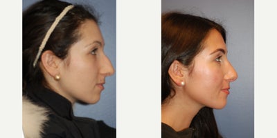 25-34 year old woman treated with Rhinoplasty - 25-34 year old woman having rhinoplasty