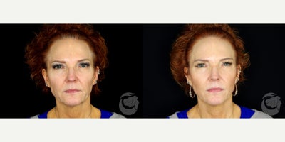 60 year old woman treated with Thread Lift - 60 year old woman treated with Thread Lift. Photos depict before and 3 months after 18 Novathreads.