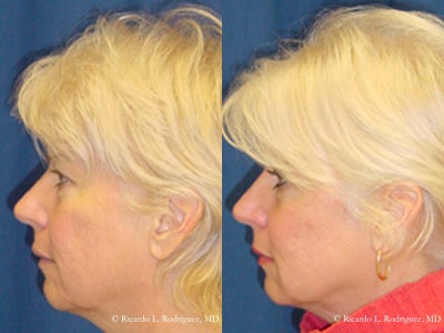 Woman in her 40s treated with Facial Fat Transfer - Woman in her 40s treated with Facial Fat Transfer to lift areas of facial structure and improve appearance of acne scarring