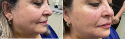 55-64 year old woman treated with Restylane Contour - Liquid facelift, and facial balancing.