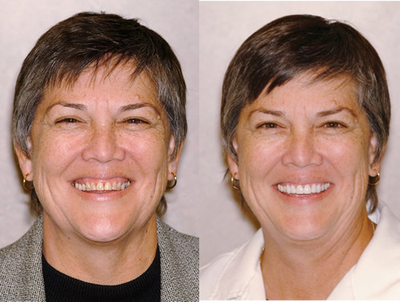 Lumineers - 
	10 Lumineers were placed to correct discoloration and to even out the teeth.
