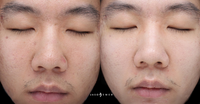 18-24 year old man treated with Cosmelan - This is a man in his 20's one month post op after Cosmelan and Fractora laser.
