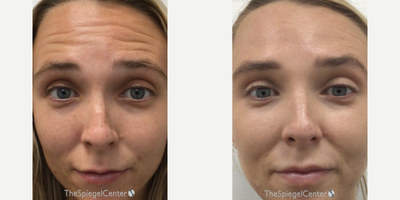 25-34 year old woman treated with Xeomin - botulinum
