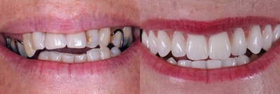 25-34 year old man treated with Dental Implants - Patient with irregularly sized teeth, improper alignment, and discoloration corrected by Dental Implant procedure.