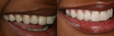 25-34 year old woman treated with Lumineers - Patient showing discolored teeth, misaligned teeth, bite impediment corrected by Lumineers.