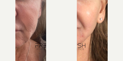 Woman treated with CoolPeel - Our patient with the Trifecta rejuvenation treatment. This treatment combines the benefits of our BBL Forever young, our Virtue RF Microneedling system with our CoolPeel laser to give you exceptional results with little to no downtime. Full face treatments take about 45-60 minutes, are virtually pain-free, and has little downtime.