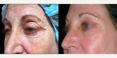 45-54 year old woman treated with DeepFX - DeepFX peri-oral + peri-orbital to address fine lines