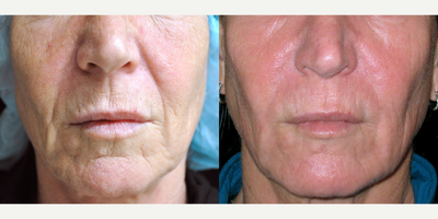 45-54 year old woman treated with DeepFX - DeepFX peri-oral + peri-orbital to address fine lines