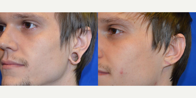 18-24 year old man treated with Ear Lobe Surgery - This man came in wanting to repair stretched earlobes. After visiting with Dr. Ho, the patient elected to undergo the earlobe repair procedure.