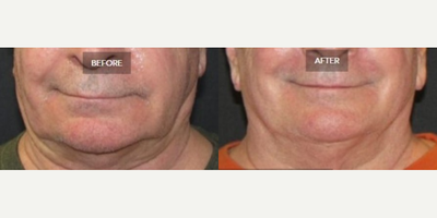 Man treated with Kybella - Man treated with Kybella