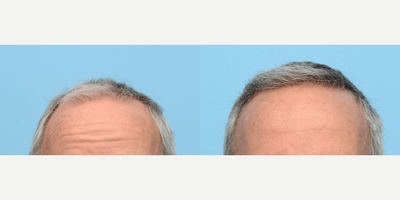 65-74 year old woman treated with FUE Hair Transplant, Hair Transplant, Hair Loss Treatment, PRP for Hair Loss, PRP Injections - 65-year-old male was presenting with traditional male pattern baldness. Patient desired hair at his receding hairline. To address increasing the volume of hair to his hairline, a follicular unit extraction (FUE) was utilized to harvest the hair follicles. The procedure involved a total of 3,050 grafts placed throughout the frontal and hairline and one treatment of PRP therapy.