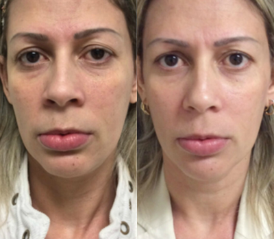 45-54 year old woman treated with Venus Legacy - Venus Legacy full face