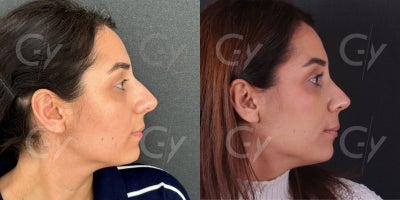 25-34 year old woman treated with Rhinoplasty - Rhinoplasty