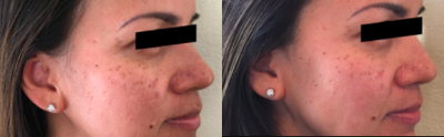 45-54 year old woman treated with Jessner Peel - The after pic is taken after 3 Jessner peels, performed 3 weeks apart.