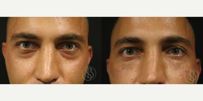 25-34 year old man treated with Injectable Fillers - 25-34 year old man treated with Injectable Fillers using1cc Teosyal Redensity 2 injected to under eye region