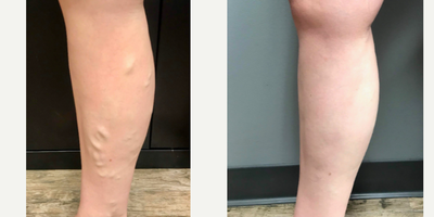 18-24 year old woman treated with EVLT - Young female patient who was experiencing swelling, aching, and tenderness in her right leg. EVLT was performed. One month post-op.
