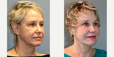 68 year old woman treated with Blue Peel - This 68 year old patient underwent a LiteLift, along with an upper and lower eyelid lift, temple lift, facial fat transfer, blue peel, and platysmaplasty. Through a hairline incision hidden within the ear, under general anesthesia, the doctor reduced the signs of aging around the jaw, neck, and lower face.