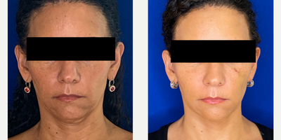 45-54 year old woman treated with Botox - 46 year old woman treated with Botox to platysma muscle on the neck to improve the sagging and with no downtime. Patient is shown before and 2 weeks after the treatment. Patient was also treated with Voluma filler to her cheeks.