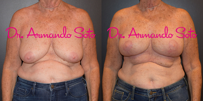 Breast Reduction - Our lovely patient had waited many years to finally be able to pursue reduction in the volume of her breasts with improvement in shape. She is very pleased with her new size, shape, and the rapidly fading scars achieved by Dr. Soto at Aesthetic Enhancements in Orlando. She is shown before, and 6 weeks after her procedure.