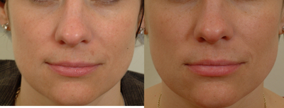 Pearl Laser Treatment - Pearl laser-one treatment