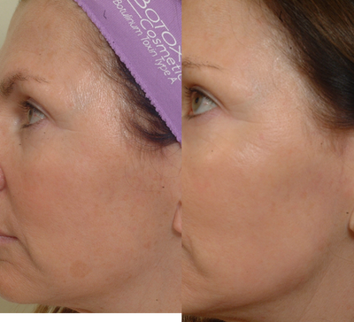 Pearl Laser Treatment - Pearl laser-one treatment