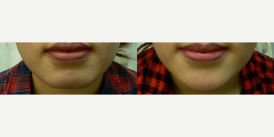 Woman treated with Botox for TMJ - Woman treated with Botox for TMJ