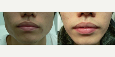 Woman treated with Botox for TMJ - Woman treated with Botox for TMJ
