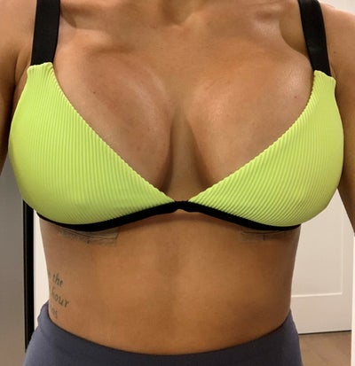 Breast Augmentation Before/After - 450cc Mentor High Profile Xtra