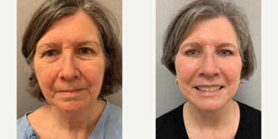 55-64 year old woman treated with Mini Facelift - S-Lift (lifting of the lower face and neck) and upper/lower eyelid surgery (blepharoplasty) in our office operating room under twilight anesthesia.
