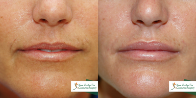 Perma Facial Implant - 	Excellent, almost immediate, lip augmentation results from lip implant in 24 year old female