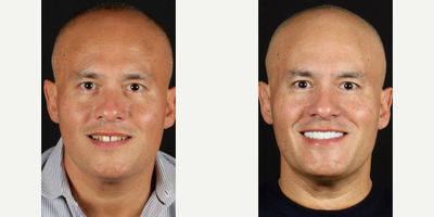 Man treated with Dental Crown - Man treated with Porcelain Veneers, Dental Crown, Dental Implants, Smile Makeover, Teeth Whitening