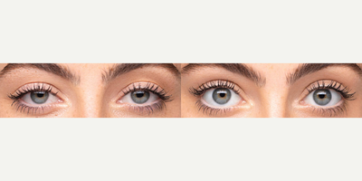 Woman treated with Upneeq - Woman treated with Upneeq