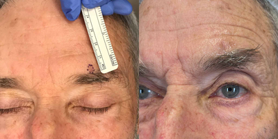 70 year old man treated with Mohs Surgery - This 70-year-old patient of ours was treated with Mohs Surgery above his eyebrow for a Basal Cell Carcinoma above his eyebrow. After 3 months any visible imperfections of the surgery are close to non-existent! The patient was very happy with his treatment results.
