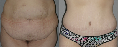 Female post-bariatric surgery - 
	Abdominoplasty with liposuction of flanks and back following bariatric surgery and massive weight loss.