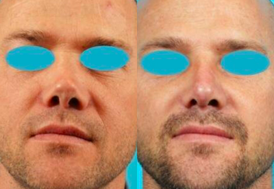 Revision rhinoplasty using rib graft - This man presented to see Dr. Ward several years after a rhinoplasty to remove a dorsal hump. He was unhappy with that concave nature of the dorsum and the upturned, pig-like tip. He underwent a rib graft and revision rhinoplasty to reconstruct the nose.
