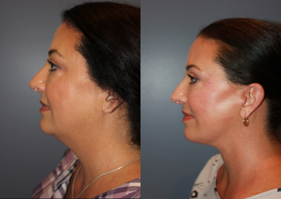 45-54 year old woman treated with Neck Lift - Neck Lift, Upper Eyelid Blepharoplasty