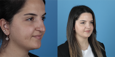 25-34 year old woman treated with Rhinoplasty - Two years post op