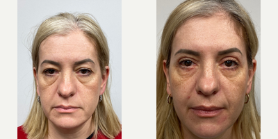 45-54 year old woman treated with Eyelid Surgery - One month after an upper and lower blepharoplasty.