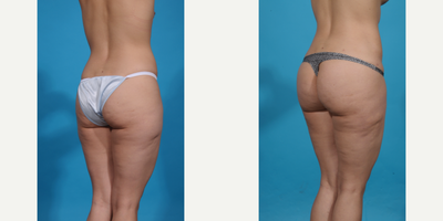 25-34 year old woman treated with Brazilian Butt Lift, Brazilian Butt Lift Revision, Butt Augmentation, Butt Lift, Liposculpture - Skinny BBL. This patient wanted better shape and curves without too much volume. A skinny BBL prioritizes shape over size and is perfect for athletic women who just need a better shape, more curves, and projection but don't want too much volume in their butt. We call this a skinny BBL.