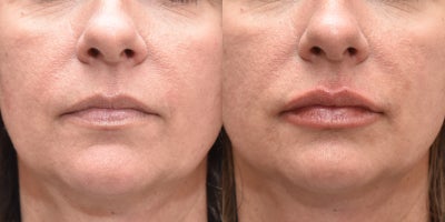 35-44 year old woman treated with Lip Fillers, Restylane Defyne - 40 year old woman treated with 1ml of Restylane Defyne