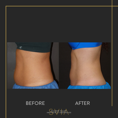 CoolSculpting before and after photo