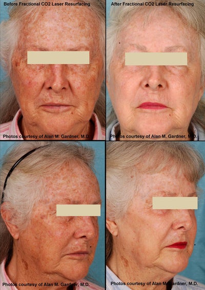 MiXto Laser before and after photo