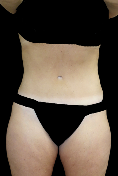Patient #17574 Bra Line Lift Before and After Photos Pittsburgh, PA -  Plastic Surgery Gallery Dr. Anna Wooten