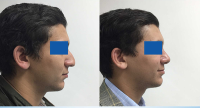 Rhinoplasty before and after photo