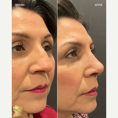 Rhinoplasty before and after photo