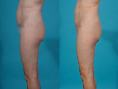 Liposuction before and after photo