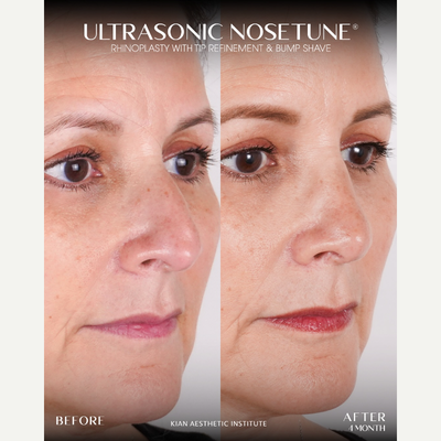 Rhinoplasty before and after photo